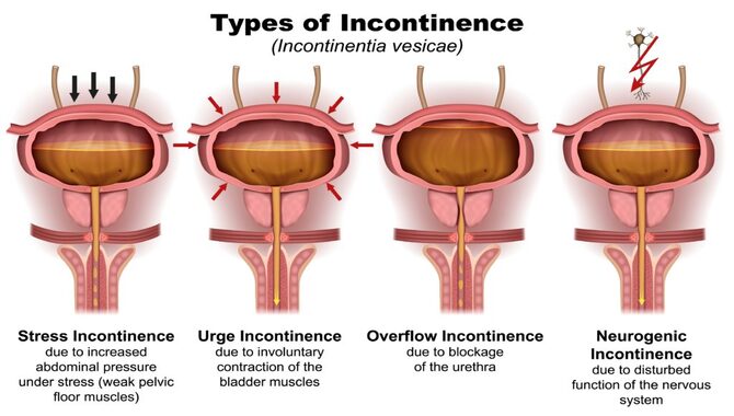 Incontinence.