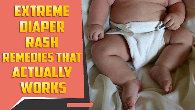 Extreme Diaper Rash Remedies That Actually Works