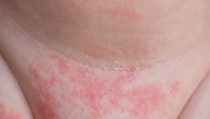 How To Prevent And Treat A Diaper Rash