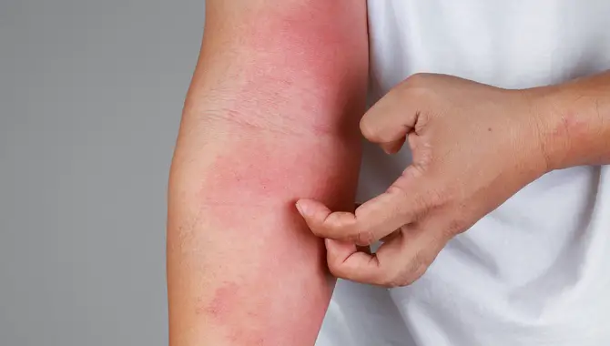 Prevent and treat skin irritation