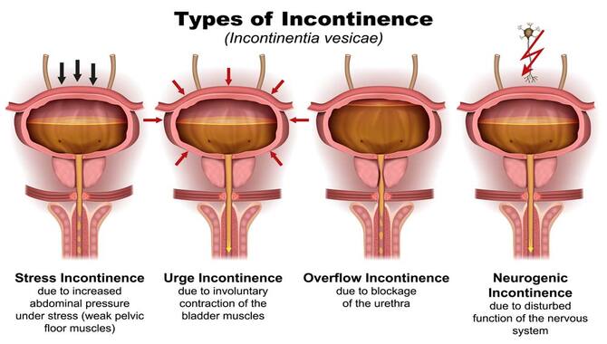 Types Of Incontinence And Their Symptoms
