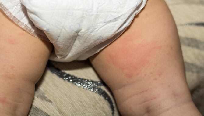 What Are The Symptoms Of Adult Diaper Rash