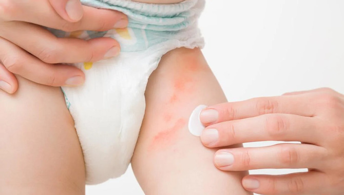 What To Do If Skin Irritation Persists Even After Trying Those