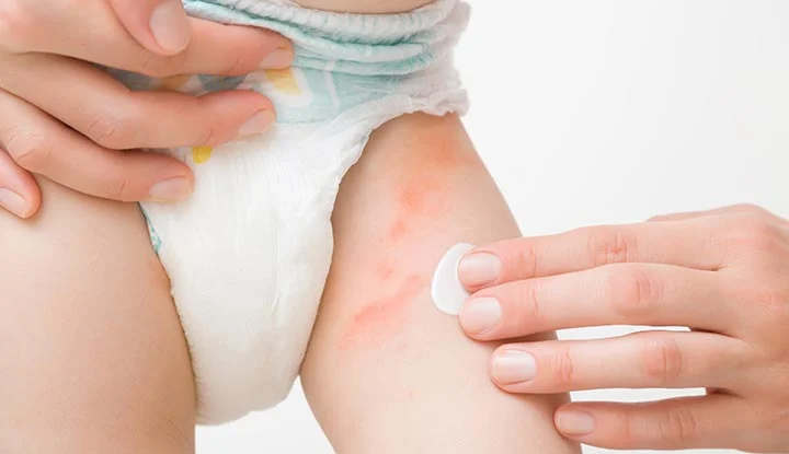 Causes And Symptoms Of Yeast Diaper Rash