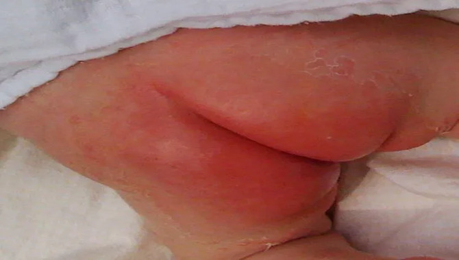 Diaper Rash Caused By Allergens
