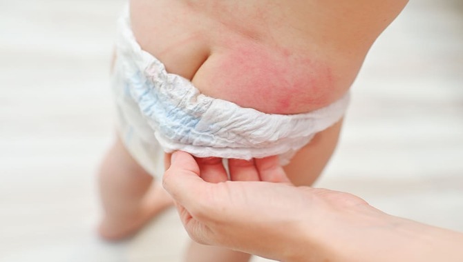 Diaper Rash Caused By Irritants