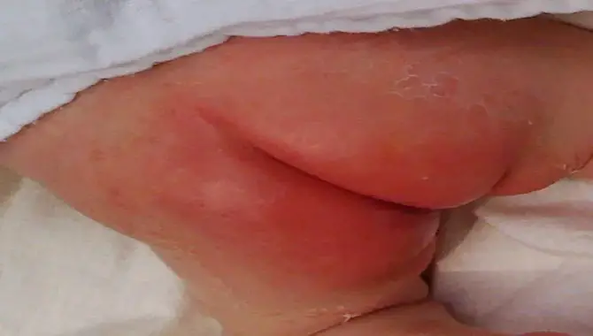 Examining What Causes Diaper Rash In Newborns