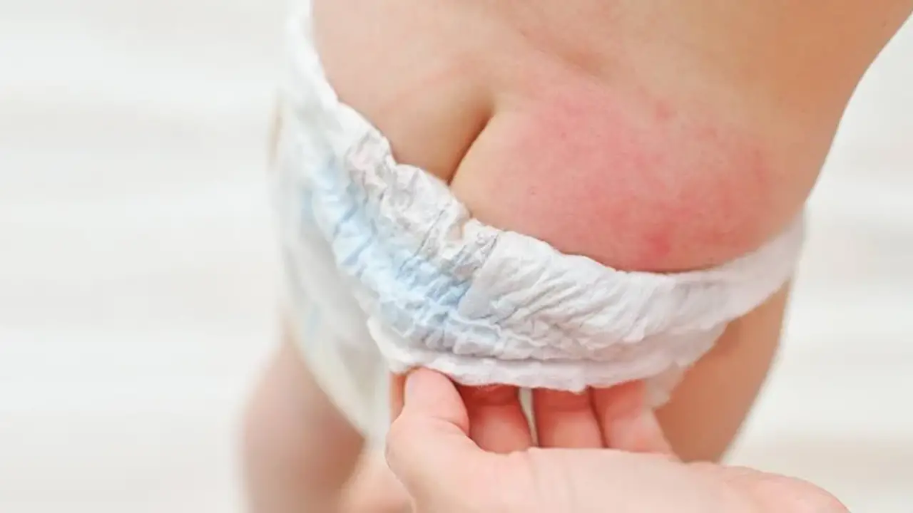 Bleeding Diaper Rash Treatment Causes, Symptoms, And Prevention