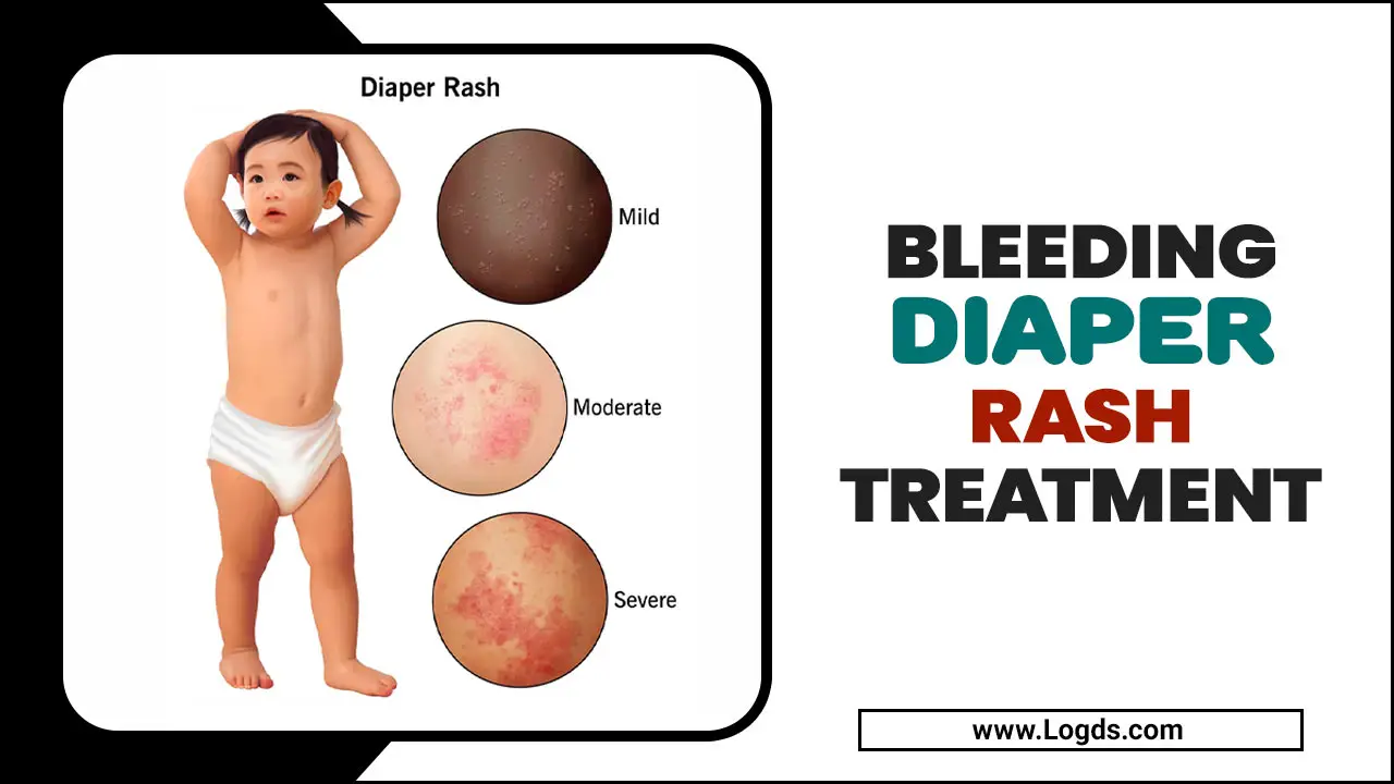 Bleeding Diaper Rash Treatment