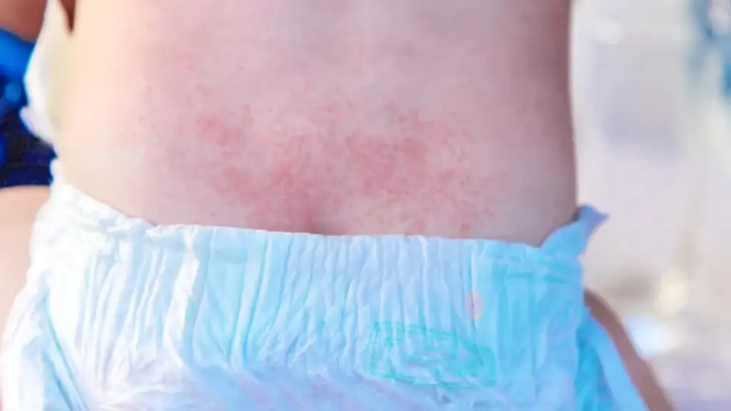 Bleeding Diaper Rash Treatment Effective Treatment