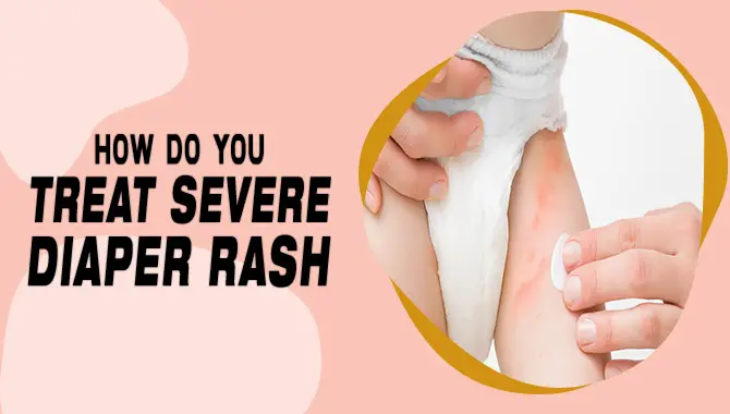 How Do You Treat Severe Diaper Rash