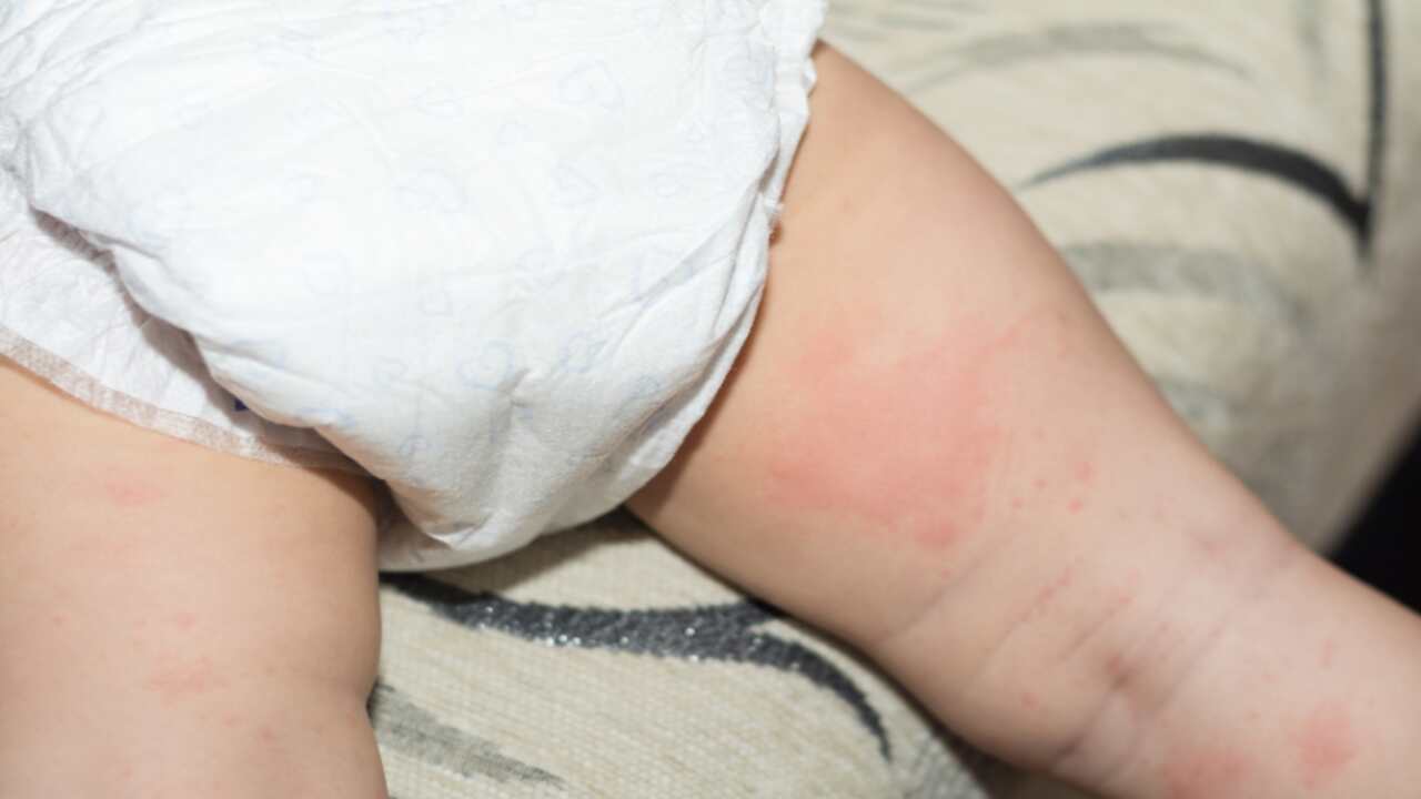 How To Prevent And Treat A Diaper Rash